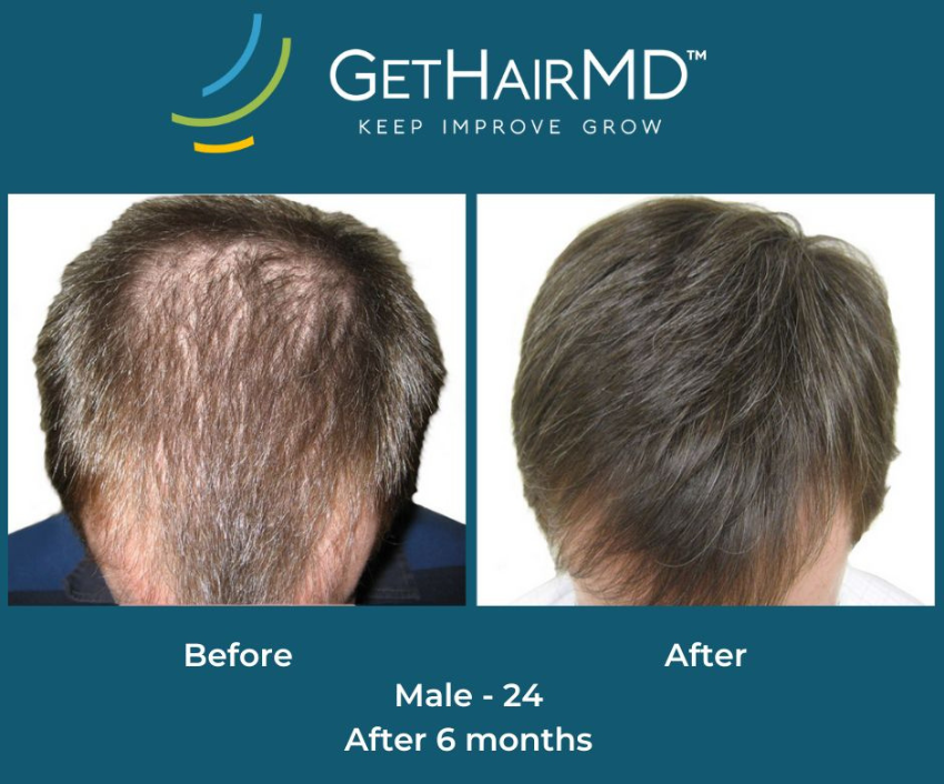 Get-Hair-MD-Before-Afters